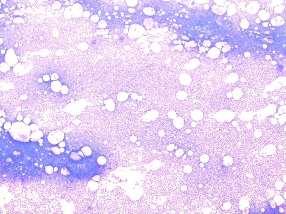Bone marrow, low power, initial diagnosis